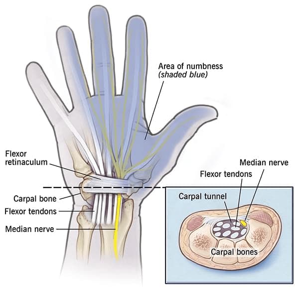 carpal tunnel syndrome surgery in tyler, exas
