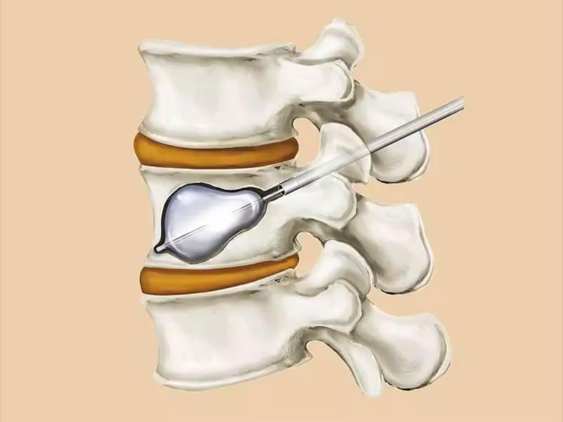 Spine Society of Europe Honors Poster On Balloon Kyphoplasty