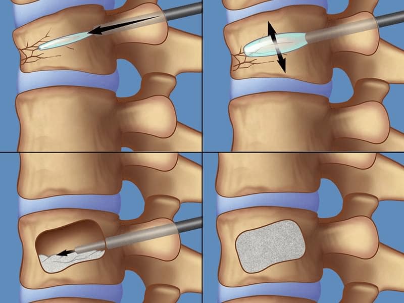 Mount Pleasant Woman First To Have Kyphoplasty Surgery at ETMC
