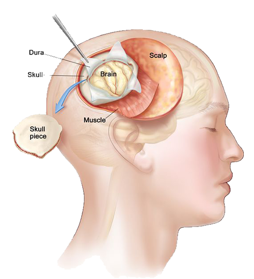 Tyler, Texas neurosurgery craniotomy experts